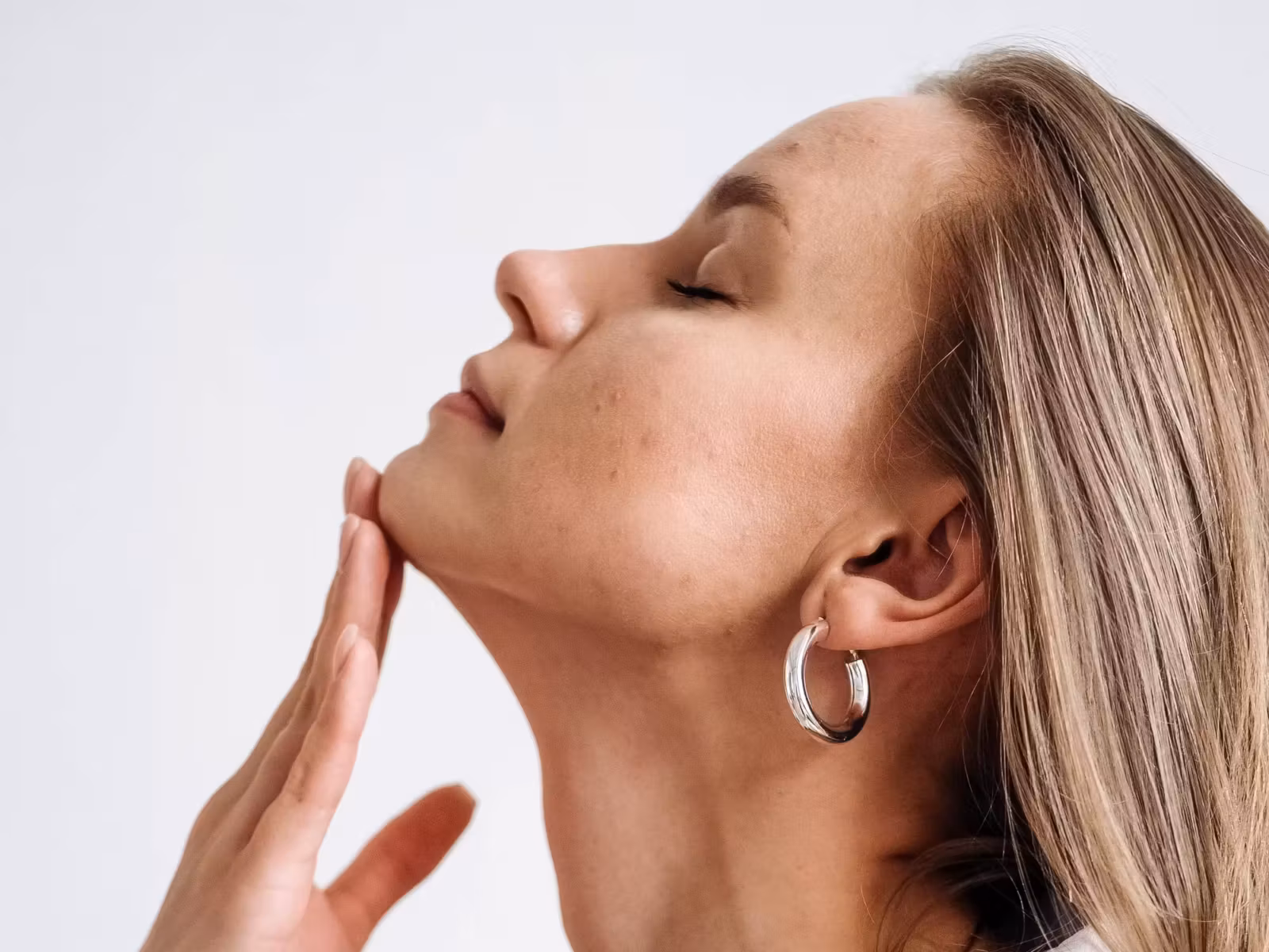 Acne da mulher adulta tem tratamento!