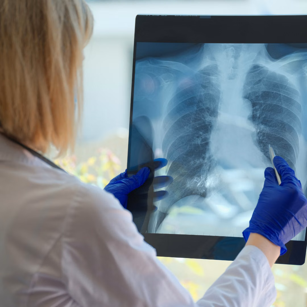Casos de síndrome respiratória aguda grave estão aumentando no país