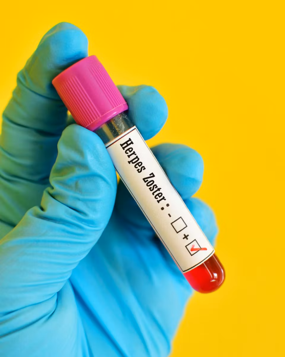 Herpes Zoster: Entenda a Doença e o Risco